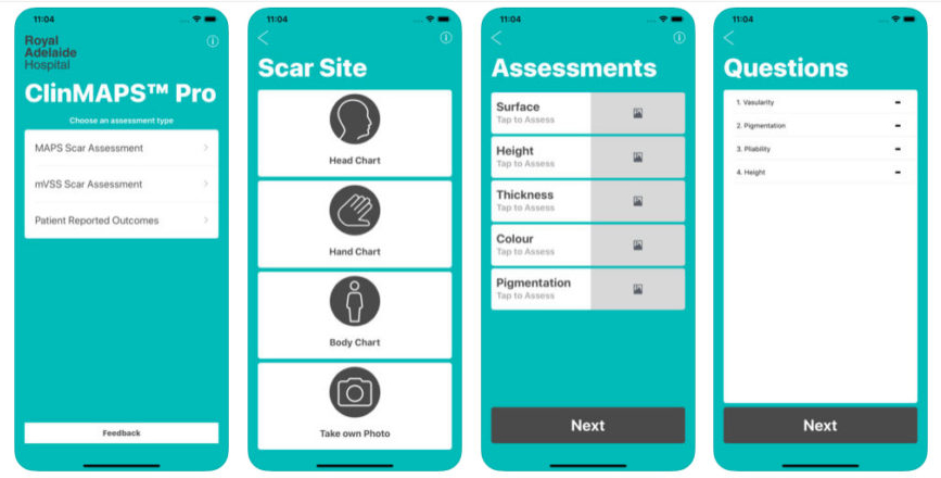 Una app permite evaluar la evolución de cicatrices producidas por quemaduras