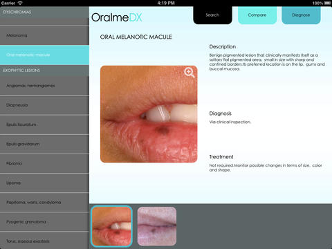 Review: OralmeDX o cómo mejorar el diagnóstico de las lesiones orales con un iPad